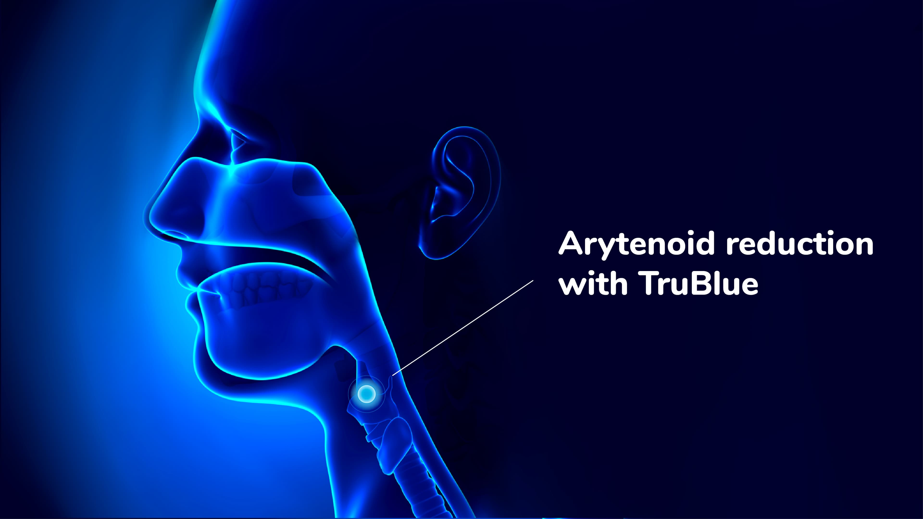 VB_links_Arytenoid_reduction_with_TruBlue.jpg